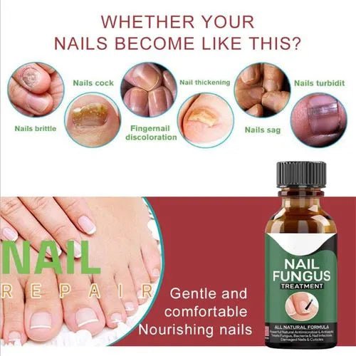 Nail Fungal Repair Serum | Nail Fungus Removal & ReGrowth Gel - dailyitems.store