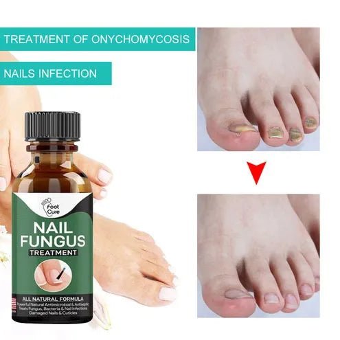 Nail Fungal Repair Serum | Nail Fungus Removal & ReGrowth Gel - dailyitems.store