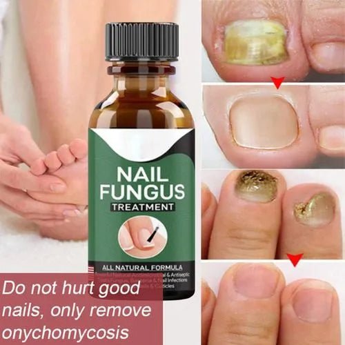 Nail Fungal Repair Serum | Nail Fungus Removal & ReGrowth Gel - dailyitems.store