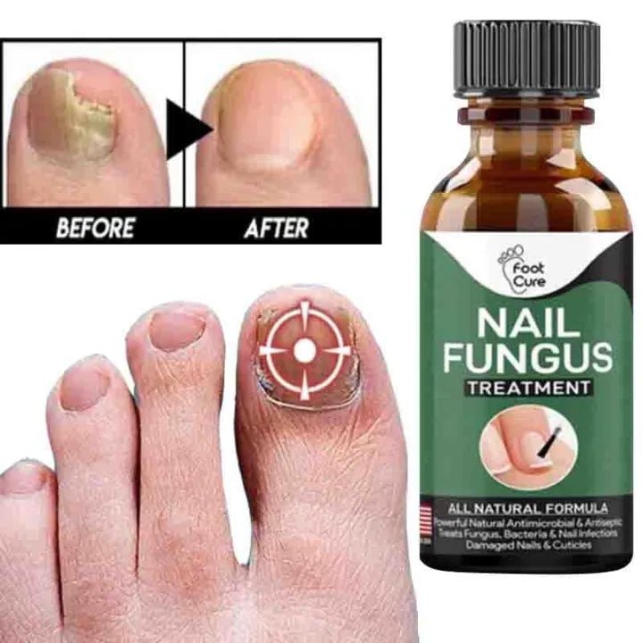 Nail Fungal Repair Serum | Nail Fungus Removal & ReGrowth Gel - dailyitems.store